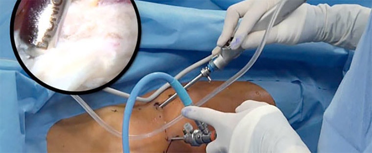 Hip Arthroscopy Hip Arthroscopy